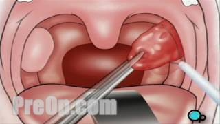 Tonsilloliths tonsil stones a patient education video by Carlo Oller MD [upl. by Naesad]