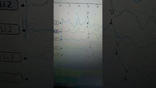 bera test for hearing Evaluation [upl. by Teahan]