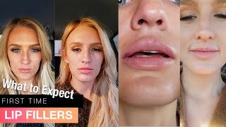 My first time getting LIP FILLERS before AND after  1 syringe Juvederm Ultra [upl. by Whittaker]