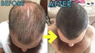 CRAZY MICRONEEDLING BEFOREAFTER RESULTS FOR HAIR REGROWTH [upl. by Aiuqram519]