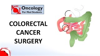 Adenocarcinoma of the Esophagus  Histopathology [upl. by Ehsom]