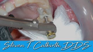 Loose Implant Screw  Dental Minute with Steven T Cutbirth DDS [upl. by Kowal538]