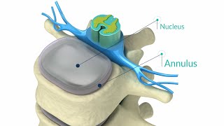 How To Heal A Painful Annular Tear  The Spine Pro [upl. by Price]