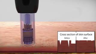 Tratamiento con Dermapen para difuminar Cicatrices y Manchas [upl. by Mixie612]