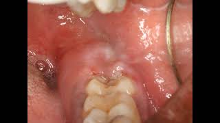 Operculectomy procedure with blade Painful swollen gum around wisdom tooth Pericoronitis Treatment [upl. by Luapsemaj]