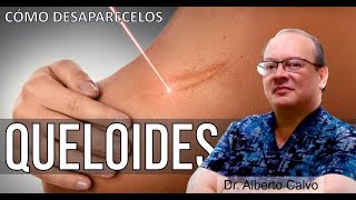 Cómo DESAPARECER las DESAGRADABLES CICATRICES QUELOIDES 🙂 Dr ALBERTO CALVO QUIROZ [upl. by Thorn]