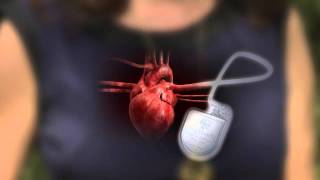 Implantable Cardioverter Defibrillator  How it works [upl. by Shiekh]