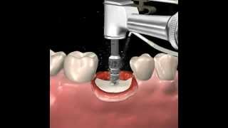 Step by step dental implant surgery Gary R OBrien DDS [upl. by Ecnahs]