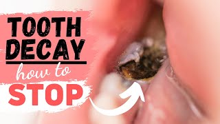 Tooth Decay Treatment for a Tooth Cavity [upl. by Esihcoc]