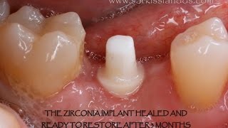 Zirconia Implant [upl. by Reviere]