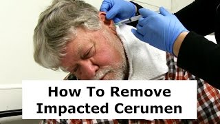 Removing Impacted Cerumen from a Patients Ear [upl. by Aderf]