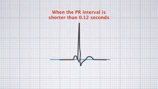 Interpreting ECG duration [upl. by Ainot233]