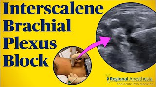 Interscalene Brachial Plexus Block [upl. by Ainoek]