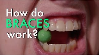 How Do Braces Work [upl. by Elysee]