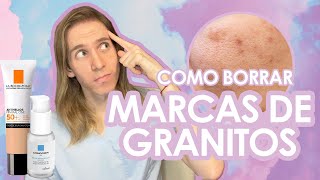 COMO BORRAR MARCAS DE ACNE de manera rápida y segura [upl. by Nilyak534]