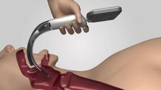 Video Laryngoscope iS3 L training video [upl. by Iahcedrom484]