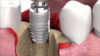 SIC invent Dental Implant Procedure SICmax implant insertion [upl. by Aikcir506]