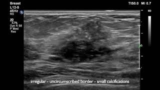 Breast Ultrasound cancer 1 [upl. by Meeharb584]