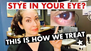 How to Get Rid of a Stye FAST  Chalazion VS Stye Treatment [upl. by Koblick]