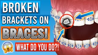 Broken Braces Brackets What You Need To Know [upl. by Eidurt201]