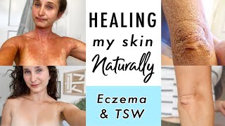 How I CURED Eczema amp Topical Steroid Withdrawal NATURALLY  My Skin Healing Journey [upl. by Ayekehs]