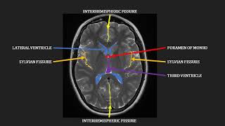 Swallowing and Communication after Stroke [upl. by Hiram]