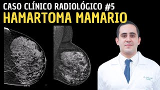 Caso Clínico Radiológico 5 Hamartoma Mamario [upl. by Wolcott821]