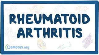 Rheumatoid arthritis  causes symptoms diagnosis treatment pathology [upl. by Kahcztiy251]