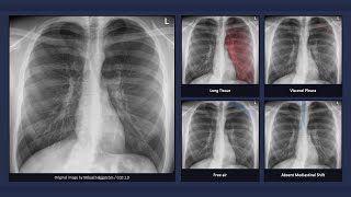 Simple Pneumothorax Explanation of Chest Xray Findings [upl. by Isbel160]