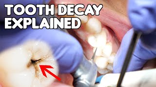 Tooth Decay Cavity Explained  Cavities vs Fillings vs Dental Caries [upl. by Leiser774]