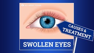 Swollen Eyelid Causes amp Treatment [upl. by Wasserman]