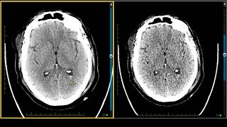 Subarachnoid Hemorrhage SAH Cerebrospinal Fluid Findings [upl. by Jegger]