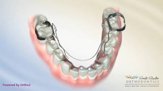 Bi HelixLower Orthodontic Appliance [upl. by Atteirneh268]