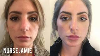 Before and After Micro Needling  Nurse Jamie [upl. by Duer]