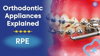 Orthodontic Appliances Explained  RPE [upl. by Farly]