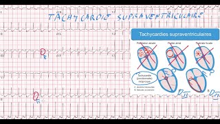 20 ECG  Quiz  Dr Synapse [upl. by Ainehs]