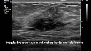 Breast ultrasound  cancer [upl. by Ennavoj841]