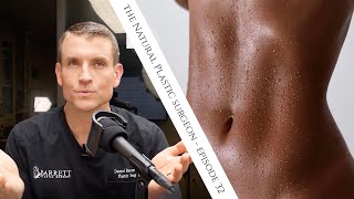 32 Everything You Need To Know About Liposuction [upl. by Havot994]