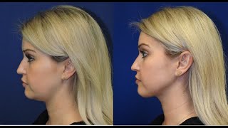 ChinNeck Liposuction Before  After  Nashville Plastic Surgeon [upl. by Valida]