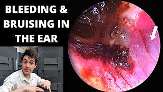 Middle Ear Myoclonus  Irregular Clicking Sound in the Ear [upl. by Conney5]