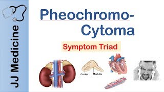 Pheochromocytoma  Symptoms and Treatment [upl. by Nick]