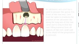 Endodontic Microsurgery [upl. by Eisenstark]