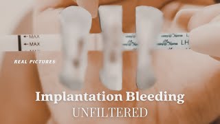 IMPLANTATION BLEEDING WITH PICTURES  Two Week Wait Bfp  Bfn Symptoms [upl. by Nybbor525]