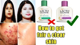 Lacto Calamine lotion reviewusesbenefitshow to get clear and fair skin [upl. by Christiane]