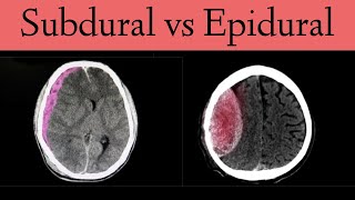 Subdural vs Epidural HematomaHemorrhage CT Scan Findings [upl. by Adriano]