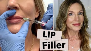 My Experience Getting Lip Filler for Vertical Wrinkles [upl. by Wallraff594]