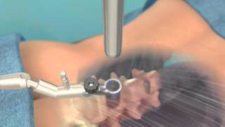 Microsurgery Training Simulation with the MicroTrainer [upl. by Thier]