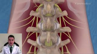Cirurgia na Coluna Lombar  Artrodese Lombar TLIF e Parafusos [upl. by Barolet]