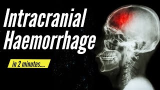 Hemorrhagic stroke epidural amp subdural hematoma  USMLE Step 1 [upl. by Hairem]