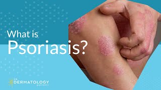 What Is Psoriasis [upl. by Suoilenroc]